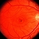 Central areolar atrophy Central areolar atrophy